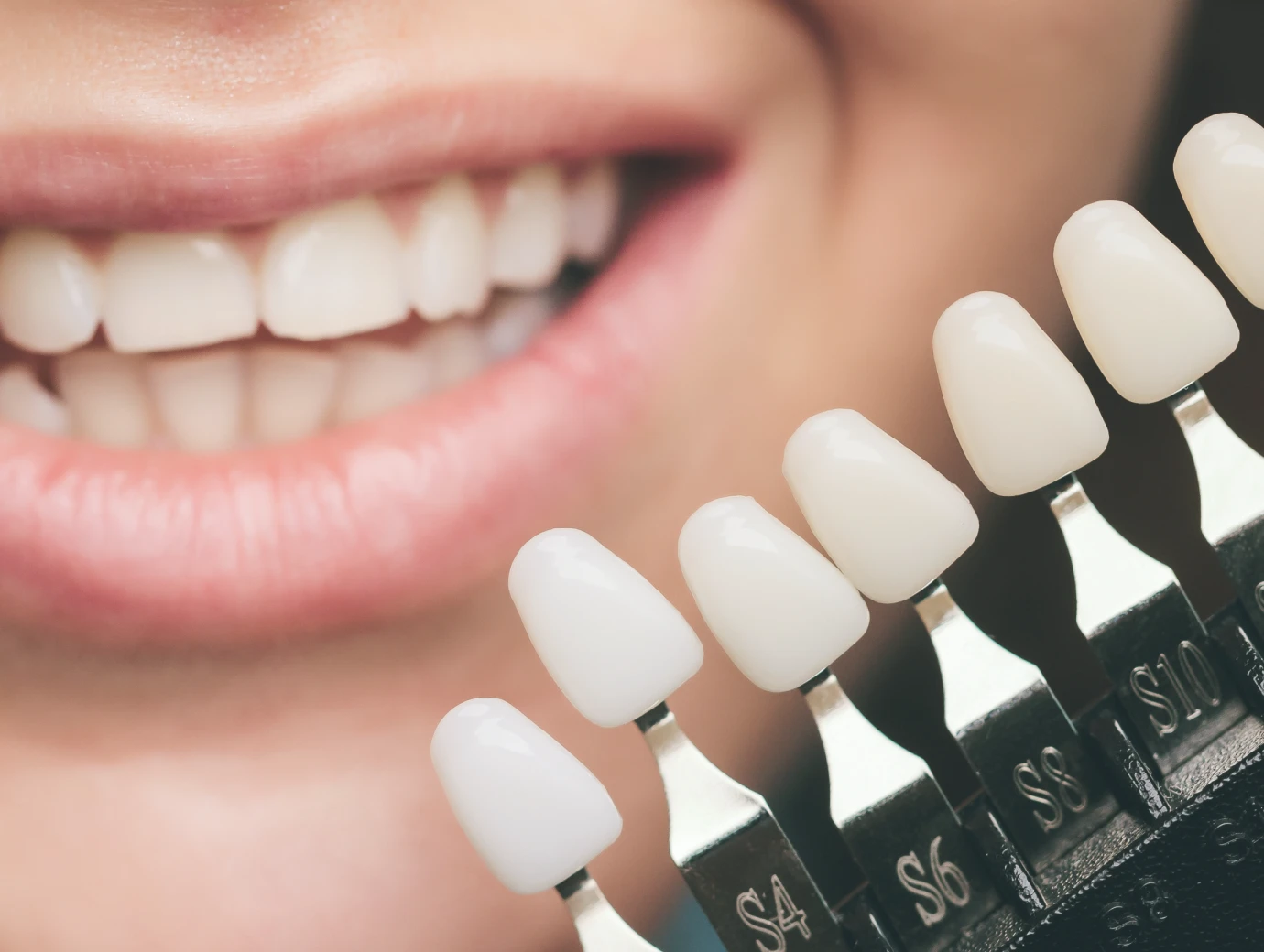 Les facettes céramiques, réhabilitation esthétique au cabinet dentaire 126 à Paris (75011)