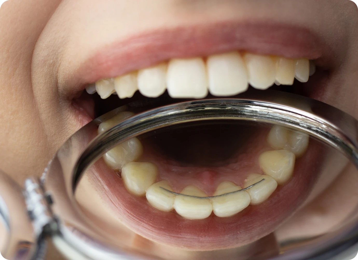 Contention esthétique fibrée au cabinet dentaire 126 à Paris (75011)