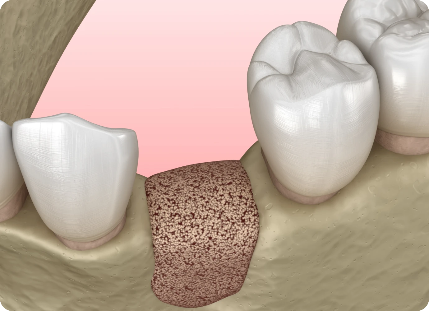 Greffe osseuse au cabinet dentaire 126 à Paris 75011