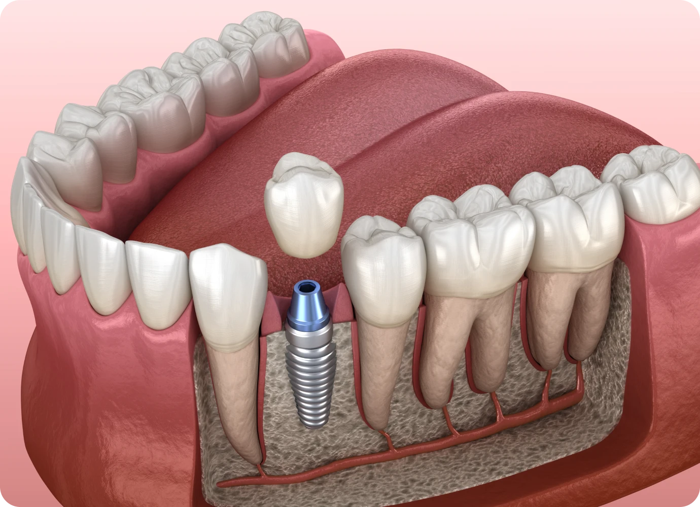 Implants dentaires, le cabinet dentaire 126 à Paris (75011)