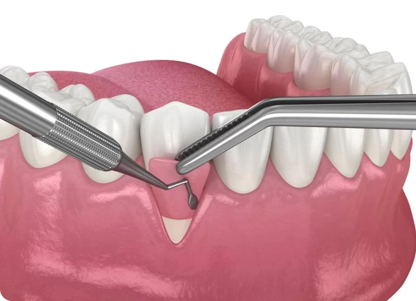 Greffe gingivale, le cabinet dentaire 126 à Paris (75011)