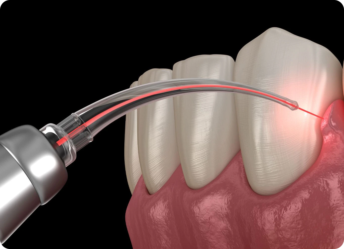 Le détartrage au laser au cabinet dentaire 126 à Paris (75011)