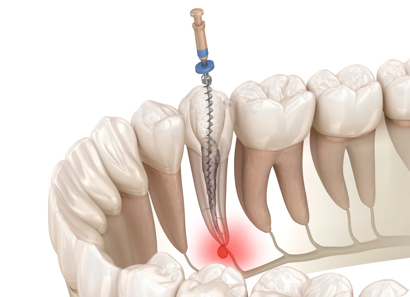 Le retraitement endodontique au cabinet dentaire 126 à Paris (75011)